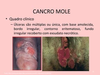 • Quadro clínico
– Úlceras são múltiplas ou única, com base amolecida,
bordo irregular, contorno eritematoso, fundo
irregular recoberto com exsudato necrótico.
32
Fonte: http://vidasaudavellgbt.files.wordpress.com/2011/06/cancro-mole2.jpg
CANCRO MOLE
 