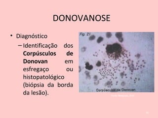 • Diagnóstico
– Identificação dos
Corpúsculos de
Donovan em
esfregaço ou
histopatológico
(biópsia da borda
da lesão).
43
Fonte: Medgrupo, 2010.
DONOVANOSE
 