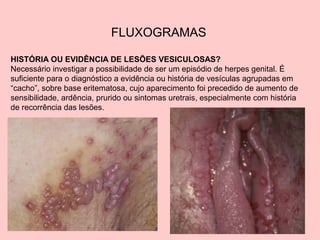 46
FLUXOGRAMAS
HISTÓRIA OU EVIDÊNCIA DE LESÕES VESICULOSAS?
Necessário investigar a possibilidade de ser um episódio de herpes genital. É
suficiente para o diagnóstico a evidência ou história de vesículas agrupadas em
“cacho”, sobre base eritematosa, cujo aparecimento foi precedido de aumento de
sensibilidade, ardência, prurido ou sintomas uretrais, especialmente com história
de recorrência das lesões.
 