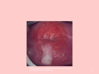 55
Fonte:
http://1.bp.blogspot.com/_WCRSnfnGC30/SANU0XjuAdI/AAAAAAAA
AFY/9EGpyM_H9Kk/s320/cervicite.png
 