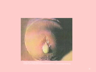 58
Fonte: http://3.bp.blogspot.com/-
5G5f2Ft7u40/TkBgwvA6FhI/AAAAAAAAAK8/9YnOd_u_QU0/s400/gonorreia.jpg
 