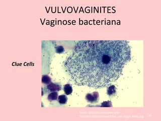 Clue Cells
Fonte: http://bacterioweb.univ-
fcomte.fr/phototheque/Clue_cell_Vagin_MGG.jpg 69
VULVOVAGINITES
Vaginose bacteriana
 