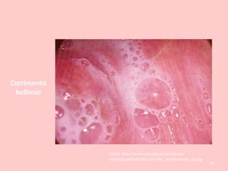 Corrimento
bolhoso
Fonte: http://www.evb.org.br/portal/wp-
content/uploads/2012/01/dst_tricomoniase_02.jpg
80
 