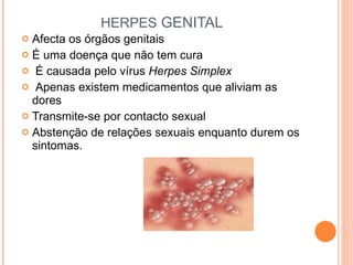 HERPES  GENITAL Afecta os órgãos genitais É uma doença que não tem cura  É causada pelo vírus  Herpes Simplex Apenas existem medicamentos que aliviam as dores Transmite-se por contacto sexual Abstenção de relações sexuais enquanto durem os sintomas. 