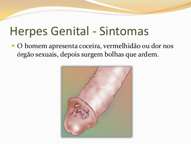 Oral & Genital Herpes Simplex Virus | Symptoms, Test ...