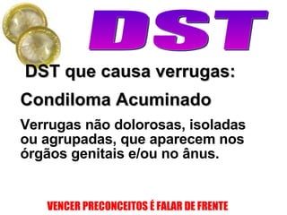 DST que causa verrugas: Condiloma Acuminado Verrugas não dolorosas, isoladas ou agrupadas, que aparecem nos órgãos genitais e/ou no ânus.  