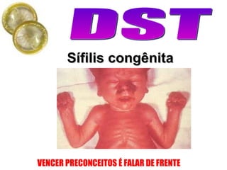 Sífilis congênita                                              