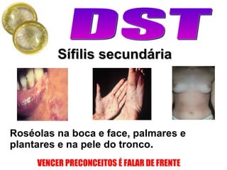 Sífilis secundária Roséolas na boca e face, palmares e plantares e na pele do tronco . 
