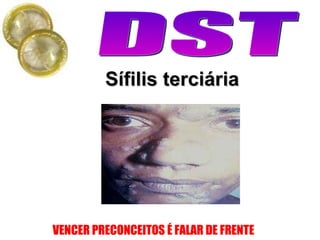Sífilis terciária 