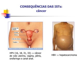 CONSEQUÊNCIAS DAS ISTs:
câncer
HBV  hepatocarcinoma
HPV (16, 18, 31, 33)  câncer
de colo uterino, vagina, pênis,
orofaringe e canal anal.
 