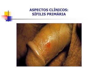 ASPECTOS CLÍNICOS:
SÍFILIS PRIMÁRIA
 