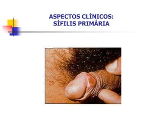 ASPECTOS CLÍNICOS:
SÍFILIS PRIMÁRIA
 
