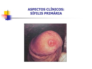 ASPECTOS CLÍNICOS:
SÍFILIS PRIMÁRIA
 