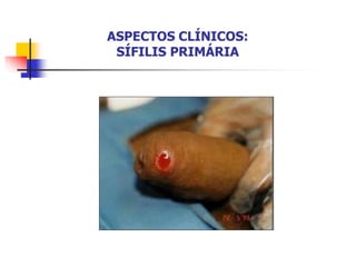 ASPECTOS CLÍNICOS:
SÍFILIS PRIMÁRIA
 
