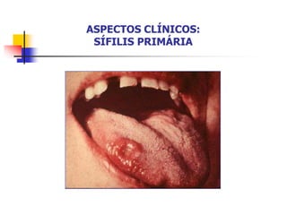 ASPECTOS CLÍNICOS:
SÍFILIS PRIMÁRIA
 