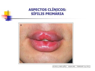 ASPECTOS CLÍNICOS:
SÍFILIS PRIMÁRIA
 