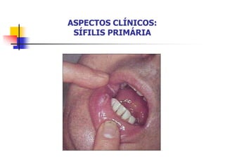 ASPECTOS CLÍNICOS:
SÍFILIS PRIMÁRIA
 
