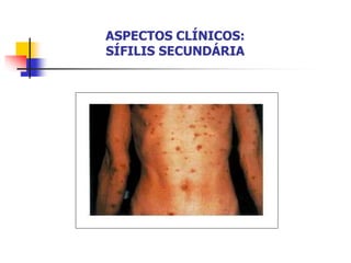 ASPECTOS CLÍNICOS:
SÍFILIS SECUNDÁRIA
 