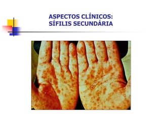 ASPECTOS CLÍNICOS:
SÍFILIS SECUNDÁRIA
 