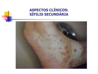 ASPECTOS CLÍNICOS:
SÍFILIS SECUNDÁRIA
 