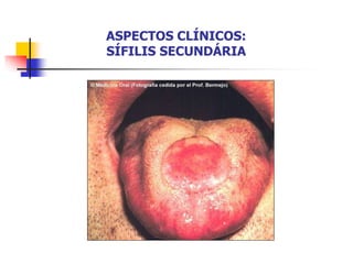ASPECTOS CLÍNICOS:
SÍFILIS SECUNDÁRIA
 