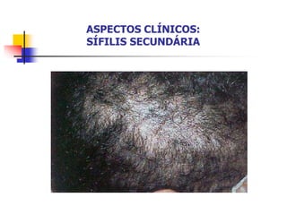 ASPECTOS CLÍNICOS:
SÍFILIS SECUNDÁRIA
 