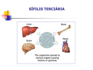 SÍFILIS TERCIÁRIA
 