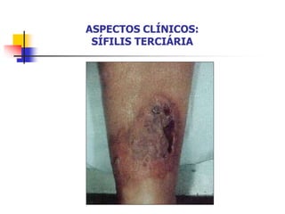 ASPECTOS CLÍNICOS:
SÍFILIS TERCIÁRIA
 