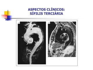 ASPECTOS CLÍNICOS:
SÍFILIS TERCIÁRIA
 