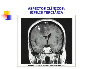 Roeske, L. C. et al. N Engl J Med 1996;335:1123
ASPECTOS CLÍNICOS:
SÍFILIS TERCIÁRIA
 