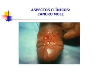 ASPECTOS CLÍNICOS:
CANCRO MOLE
 