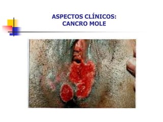 ASPECTOS CLÍNICOS:
CANCRO MOLE
 