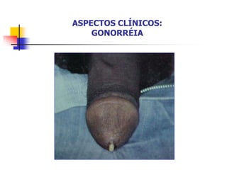 ASPECTOS CLÍNICOS:
GONORRÉIA
 