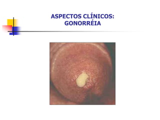 ASPECTOS CLÍNICOS:
GONORRÉIA
 