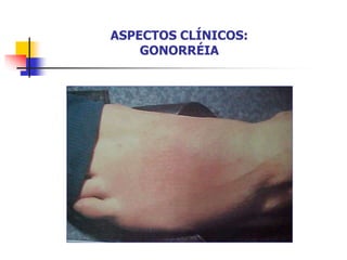 ASPECTOS CLÍNICOS:
GONORRÉIA
 