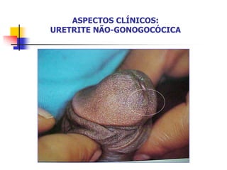 ASPECTOS CLÍNICOS:
URETRITE NÃO-GONOGOCÓCICA
 