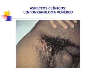 ASPECTOS CLÍNICOS:
LINFOGRANULOMA VENÉREO
 