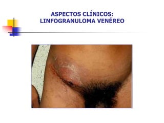 ASPECTOS CLÍNICOS:
LINFOGRANULOMA VENÉREO
 