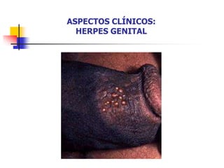 ASPECTOS CLÍNICOS:
HERPES GENITAL
 
