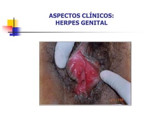 ASPECTOS CLÍNICOS:
HERPES GENITAL
 