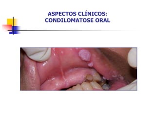 ASPECTOS CLÍNICOS:
CONDILOMATOSE ORAL
 