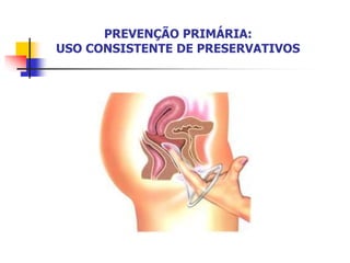 PREVENÇÃO PRIMÁRIA:
USO CONSISTENTE DE PRESERVATIVOS
 