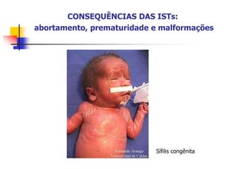 CONSEQUÊNCIAS DAS ISTs:
abortamento, prematuridade e malformações
Sífilis congênita
 