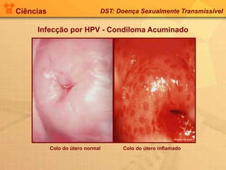Ciências DST: Doença Sexualmente Transmissível
Infecção por HPV - Condiloma Acuminado
Arquivo do autor
Colo do útero normal Colo do útero inflamado
 