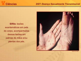 Ciências DST: Doença Sexualmente Transmissível
Sífilis: lesões
exantemáticas em pele
do corpo, acompanhadas
dessas lesões em
palmas de mãos e/ou
plantas dos pés.
Arquivo do autor
 