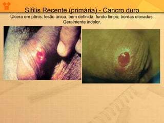 Sífilis Recente (primária) - Cancro duro
Úlcera em pênis: lesão única, bem definida; fundo limpo; bordas elevadas.
Geralmente indolor.
 