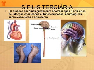 • Os sinais e sintomas geralmente ocorrem após 3 a 12 anos
de infecção com lesões cutâneo-mucosas, neurológicas,
cardiovasculares e articulares.
SÍFILIS TERCIÁRIA
 