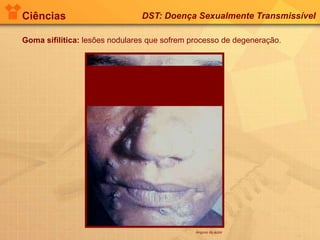 Ciências DST: Doença Sexualmente Transmissível
Goma sifilítica: lesões nodulares que sofrem processo de degeneração.
Arquivo do autor
 