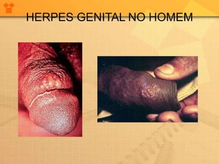 HERPES GENITAL NO HOMEM
 