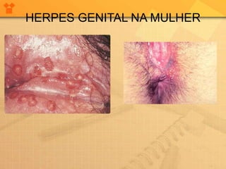 HERPES GENITAL NA MULHER
 